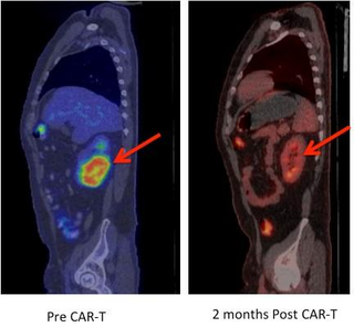 Before and after image shows lymphoma regression after CAR T-cell therapy. Credit: Fred Hutch News Service
